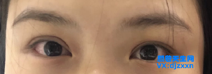 两侧不对称.png
