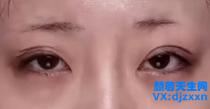 多层眼皮无神.png