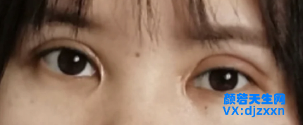 肉条不对称增生明显.png